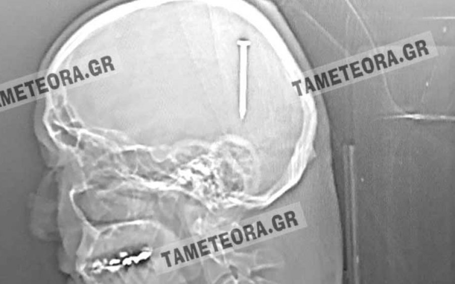 Σπάνιο περιστατικό – θαύμα για Καλαμπακιώτη, που του μπήκε καρφί στο κεφάλι!